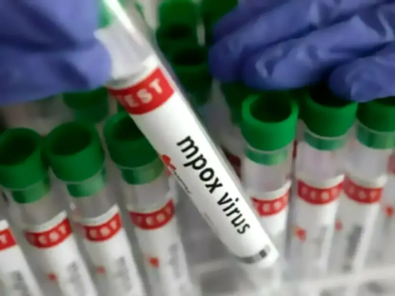 Karachi Reports Ninth Mpox Case; Patient Admitted to Isolation Ward
